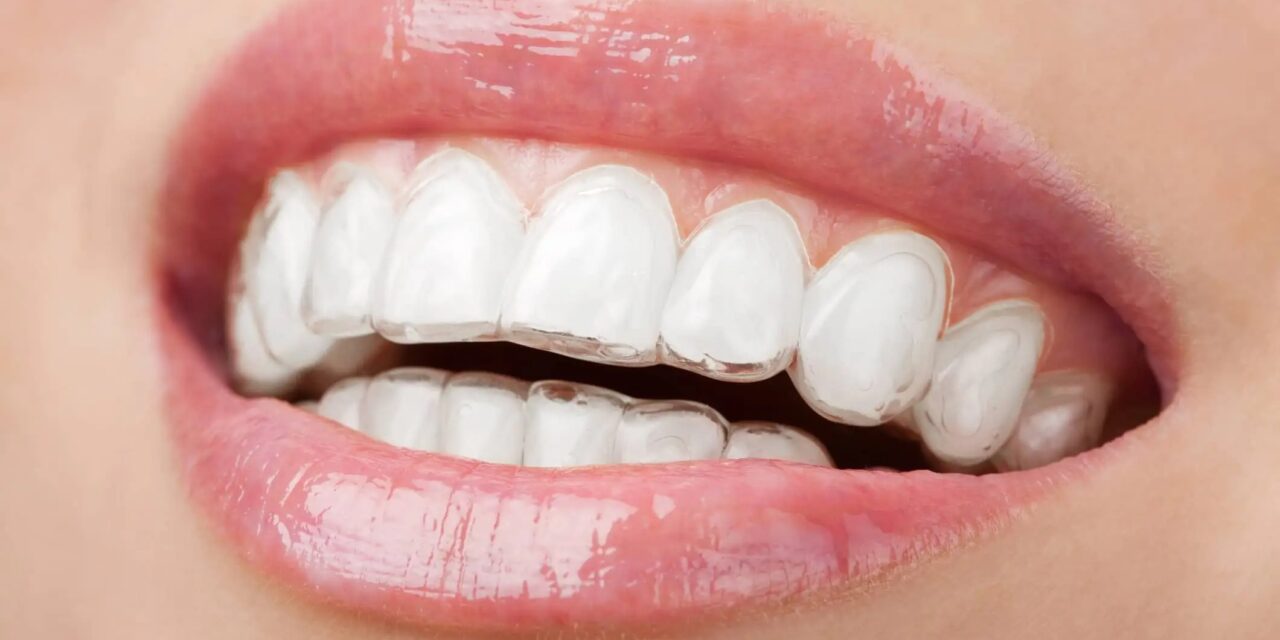 Aligneurs Transparents à Nador : L’Orthodontie Invisible par le Dr. Challali