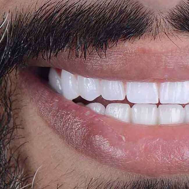 https://docteurchallali.com/wp-content/uploads/2026/03/imgi_24_hollywood-smile-01a-e1774858953485.jpg