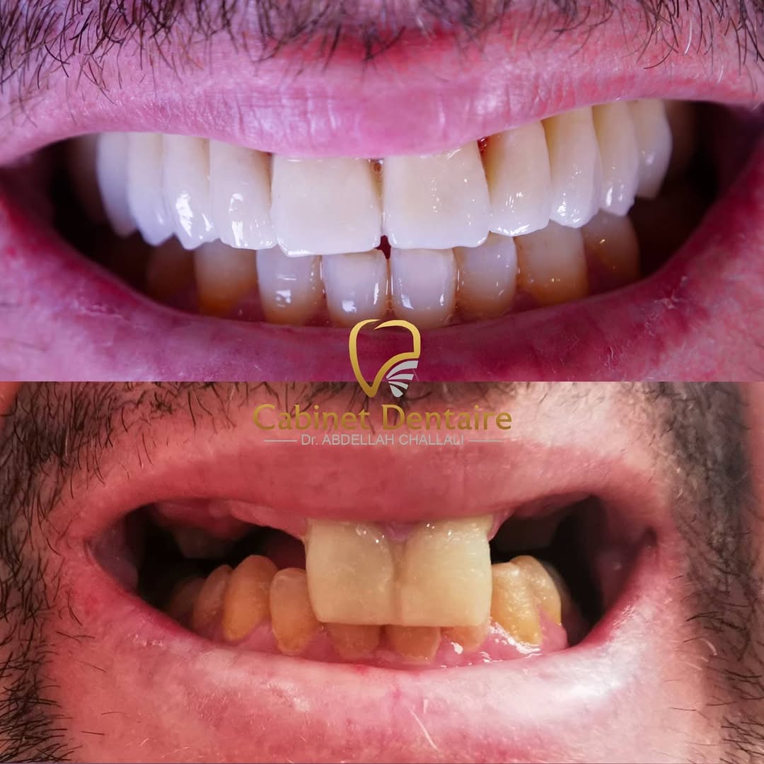 https://docteurchallali.com/wp-content/uploads/2026/04/ابتسامتكم-عملنا،-ارضاؤكم-هدفنا.من-أعمال-عيادة-الدكتور-عبد-الله-شلالي.♥️♥️♥️للإجابة-على-كل-تساؤلا.jpg