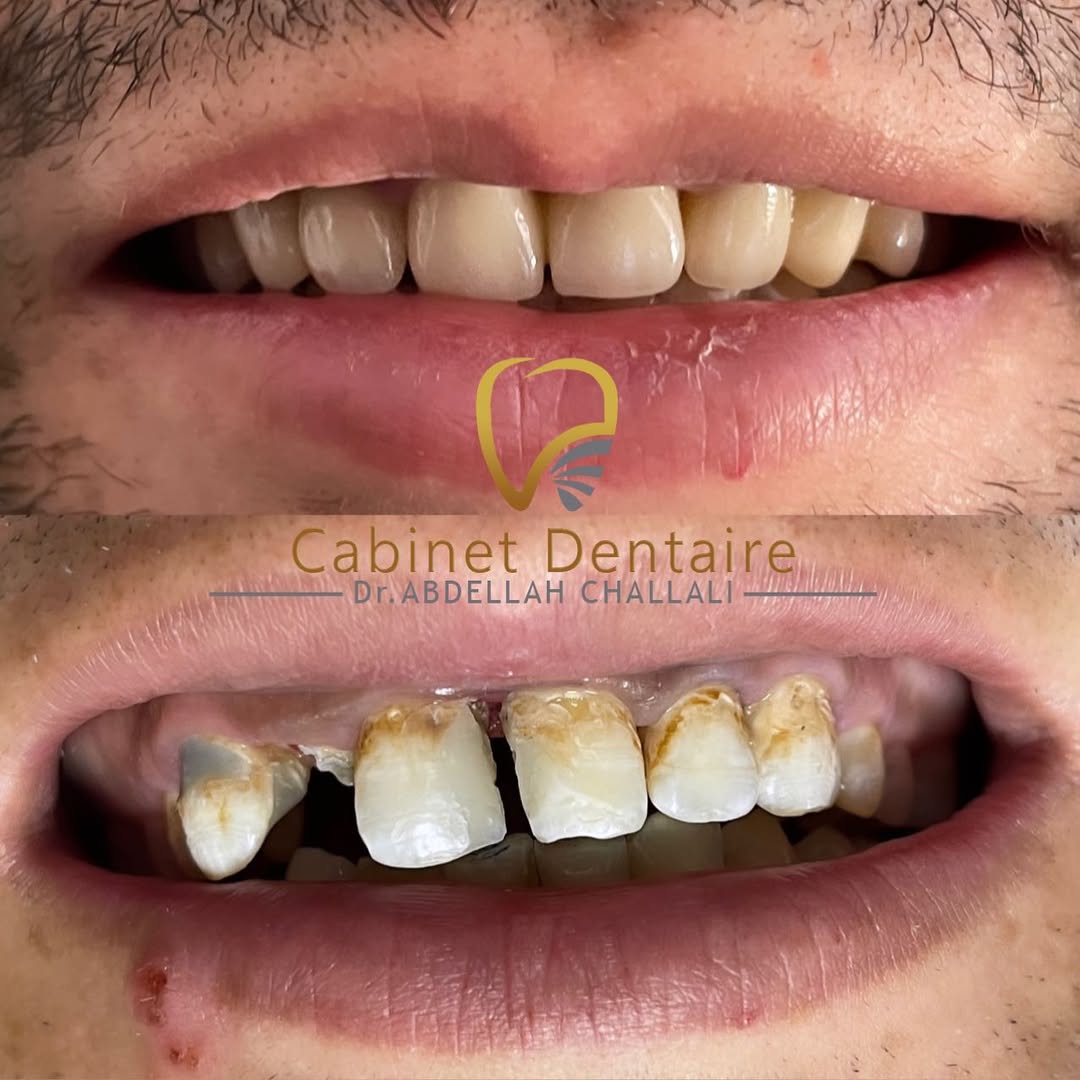 عيادة الدكتور عبد الله شلالي تشكركم على ثقتكم. وتعدكم الأفضل في مجال طب وتجميل الأسنان.للإجابة https://docteurchallali.com/wp-content/uploads/2026/04/عيادة-الدكتور-عبد-الله-شلالي-تشكركم-على-ثقتكم.-وتعدكم-الأفضل-في-مجال-طب-وتجميل-الأسنان.للإجابة-.jpg